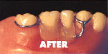 partial bridge after laser welding