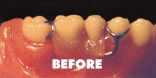 partial bridge before laser welding