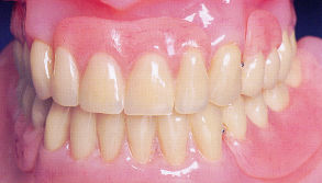 Vitallium EsthetiClasp