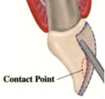 empress-interproximal-extenton