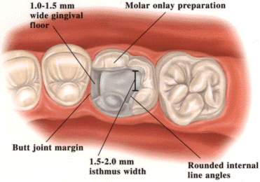 empress-molar-prep