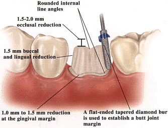 empress-posterior-crown