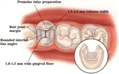 empress-premolar-prep