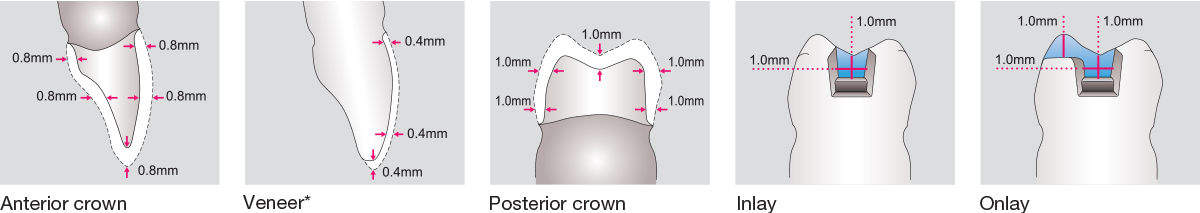 Zirconia STML Minimal Wall Thickness